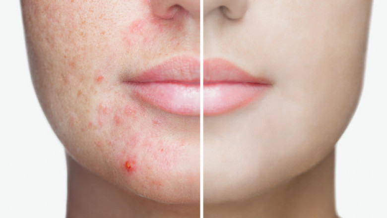 The Benefits of Salicylic Acid for Acne