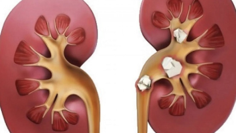 The Power of Ayurvedic Treatment For Kidney Stone: Healing Without Surgery