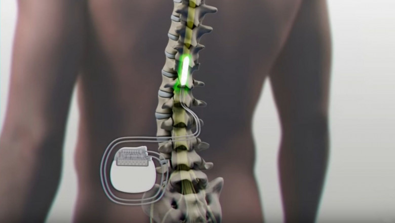 The Intrathecal Pumps Market: Revolutionizing Pain Management