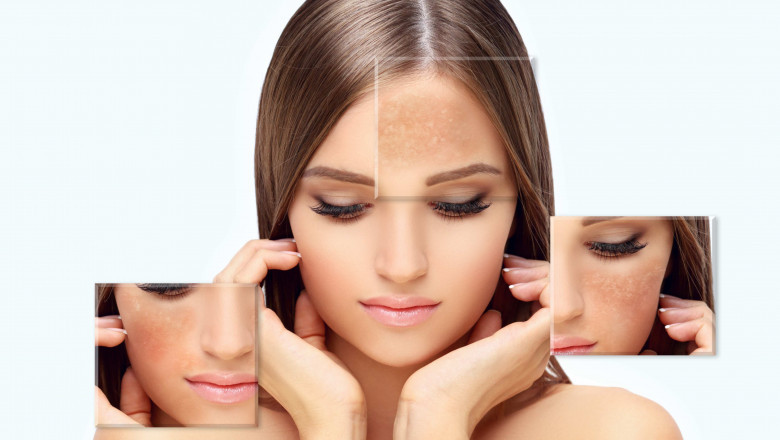 The Science Behind Skin Pigmentation: Causes, Myths, and Treatment Options