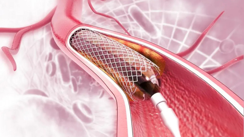India Coronary Stents Market Set to Grow with Bioabsorbable Scaffold Tech