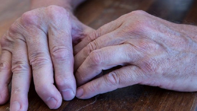 Psoriatic Arthritis Treatment Market Estimated to Witness Growth from Biologic Therapies