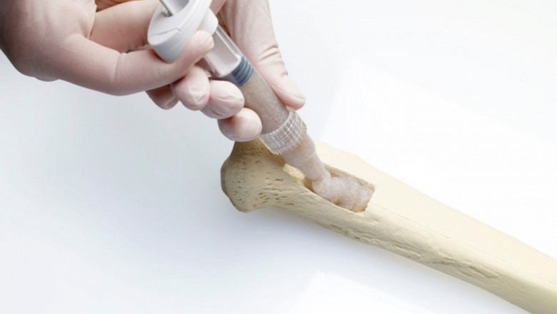 Bioactive Materials Market Growth Amid Surgical Innovation