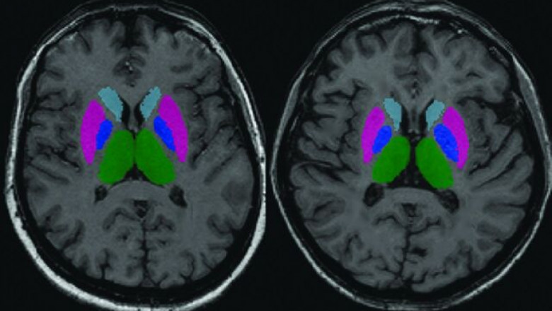 Clinically Isolated Syndrome Market Size Forecast and Trends