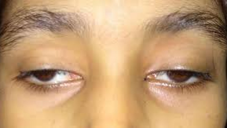 Global Ophthalmoplegia Market Growth &amp; Investment Outlook