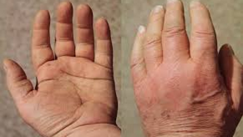 Polymyalgia Rheumatica Drugs Market Growth  Opportunities