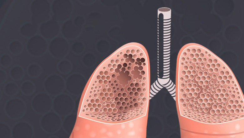 Global Emphysema Market Size, Trends, Growth Outlook
