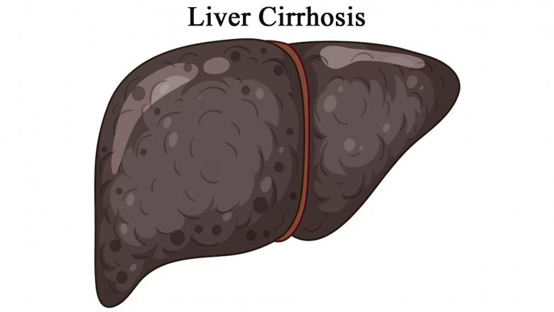 Liver Cirrhosis Market Size, Trends, and Growth Forecast 2025-2032