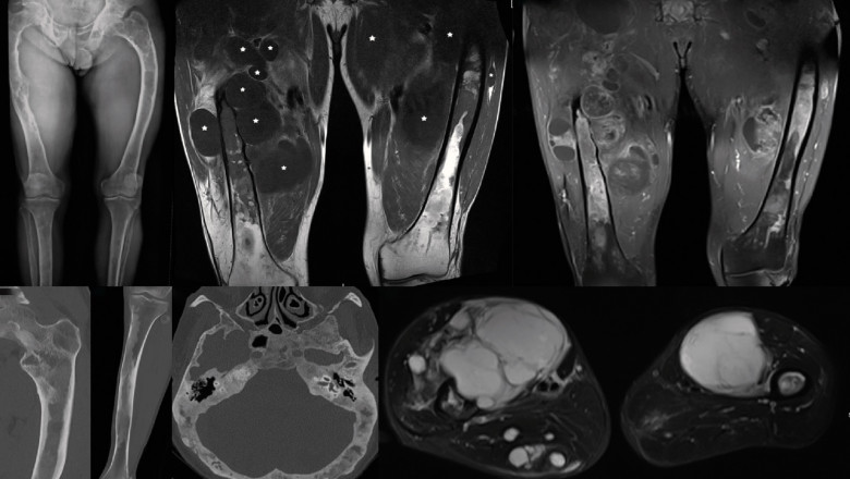 Soft Tissue Sarcoma Market: Size, Trends, and Growth Opportunities 2025-2032