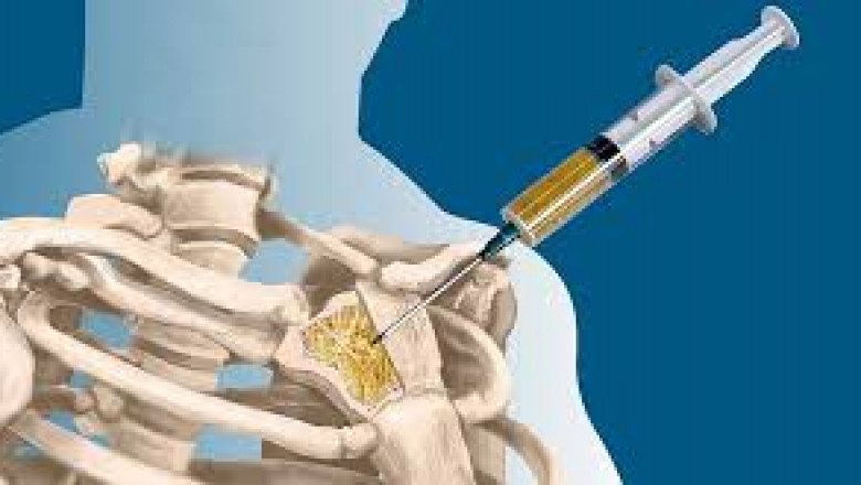 Comprehensive Analysis of the Bone Biopsy Market Size and Growth Trends