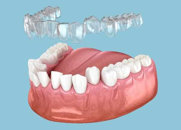 Invisalign Glasgow 