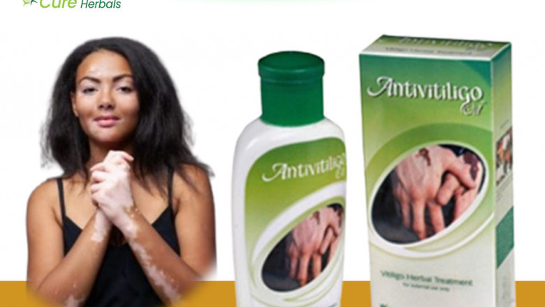 Order Homeopathic Herbal Treatments for Vitiligo Pigmentation