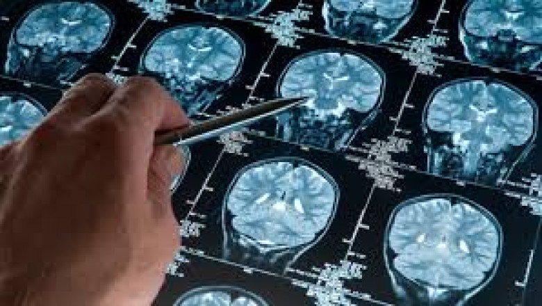 Mtor Inhibitors Market Set to Surge with Targeted Therapy