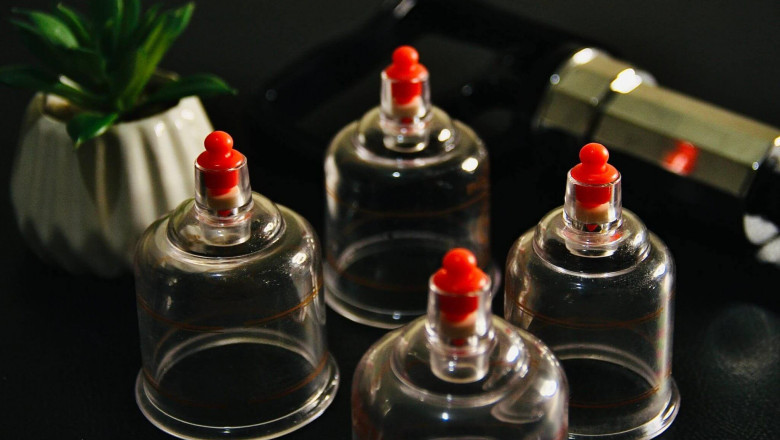 Trusted Chinese Cupping Treatment for Melbourne Patients