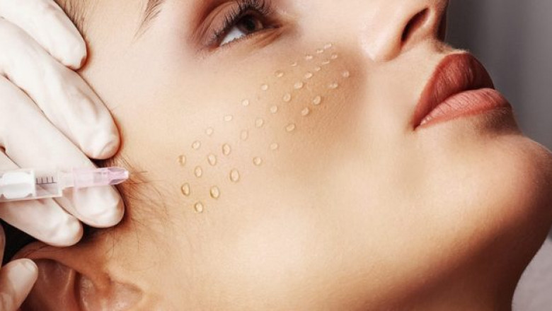 Mesotherapy Market: Blending Science and Aesthetics for Personalized Wellness