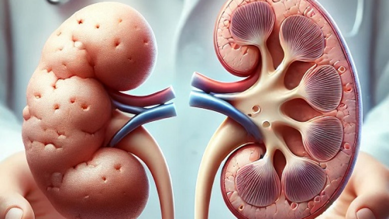 The Power of Ayurvedic Treatment For Kidney Shrinkage: Healing Kidneys Naturally