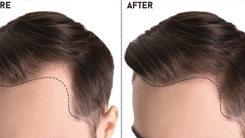 Choosing Excellence: The Ultimate Guide to Finding the Best Hair Transplant in Islamabad
