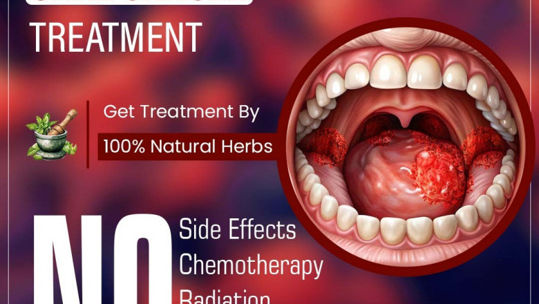 Best Oral Cancer Treatment Hospitals in Chennai