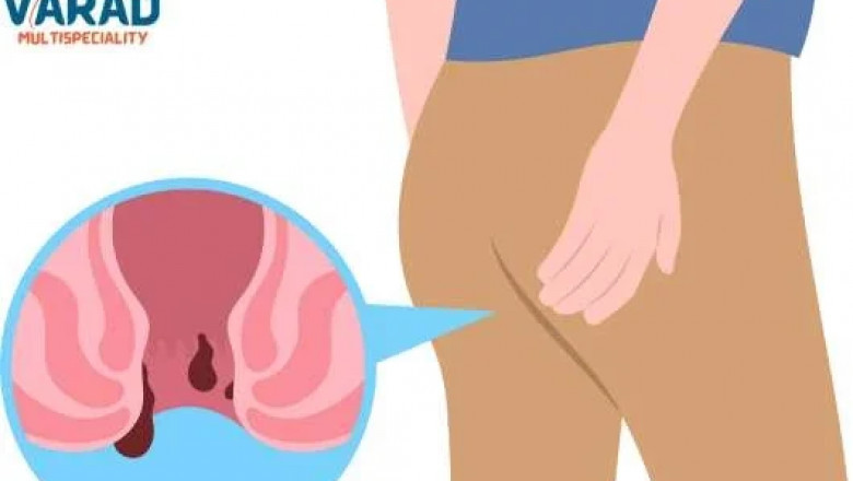 Expert Piles Treatment in Pune: Everything You Need to Know