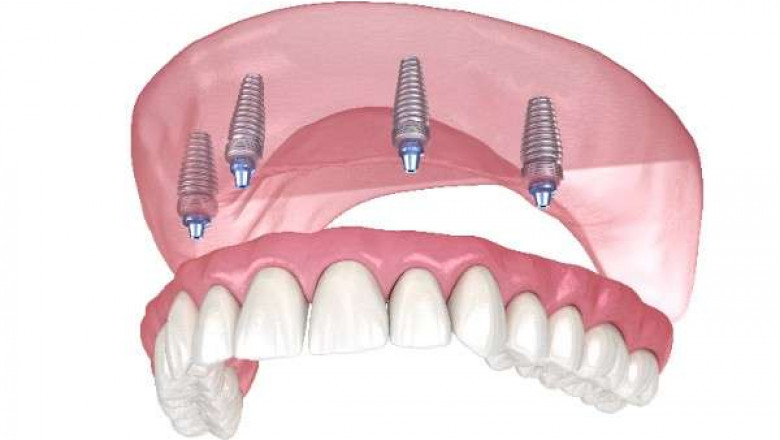 Personalised Smile Services That Fit Your Goals in Eastleigh