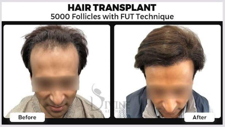 The Ultimate Guide to Hair Transplant in Gurgaon and Noida by Dr. Amit Gupta
