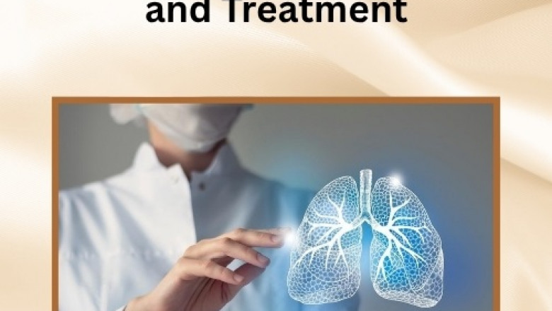 Bronchiectasis Symptoms and Treatment: What You Need to Know to Stay Ahead
