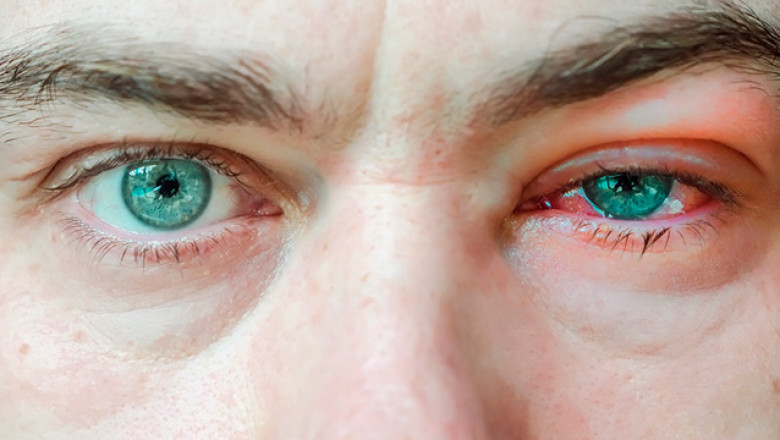 Viral Conjunctivitis Drugs Market: Growth, Segments & Strategies