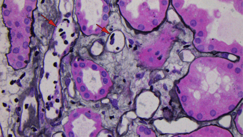 Antibody-mediated Rejection Market Dynamics and Growth Trajectory