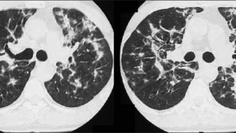 Bronchiolitis Obliterans Syndrome Market Growth Prospects Unveiled