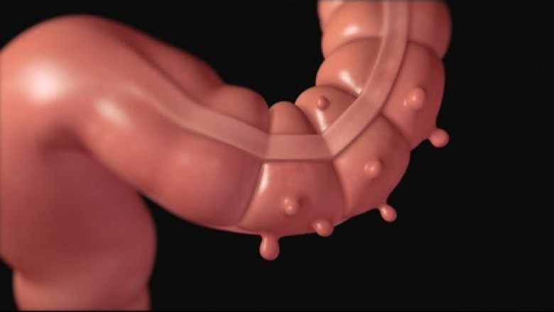 Diverticulitis Market Growth Trends and Opportunities Outlook
