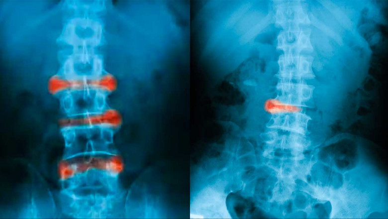 Global Axial Spondyloarthritis Treatment Market Forecast 2025-2032