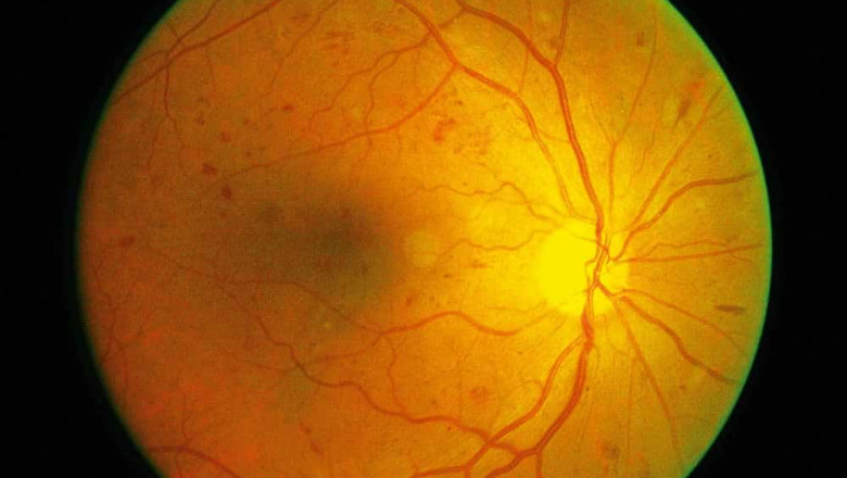 Proliferative Diabetic Retinopathy Market to Surge Driven by Anti-VEGF Innovations