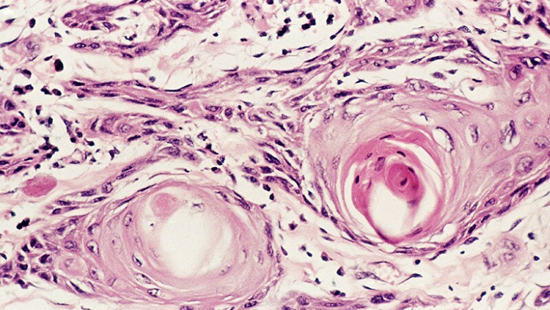 Advanced Non-Squamous and Squamous NSCLC Market Growth Dynamics