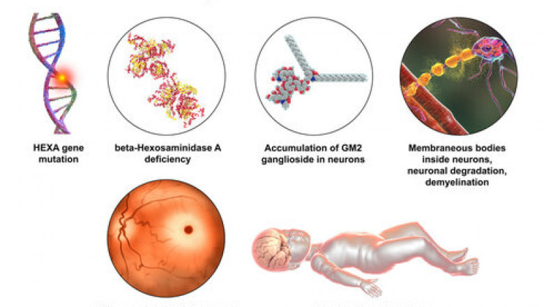 Global Tay-Sachs Disease Treatment Market Growth Outlook