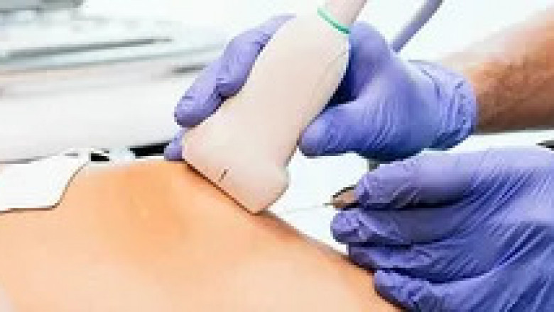 Viscosupplementation Market Size, Growth, and Strategic Outlook 2025-2032