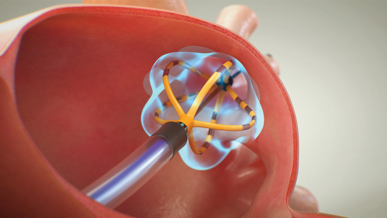 Pulsed Field Ablation Market Size, Trends, and Growth Outlook 2025-2032