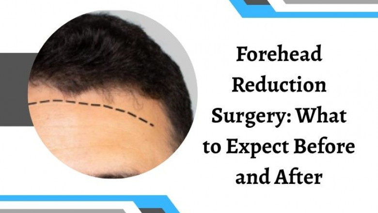 Forehead Reduction Surgery: What to Expect Before and After