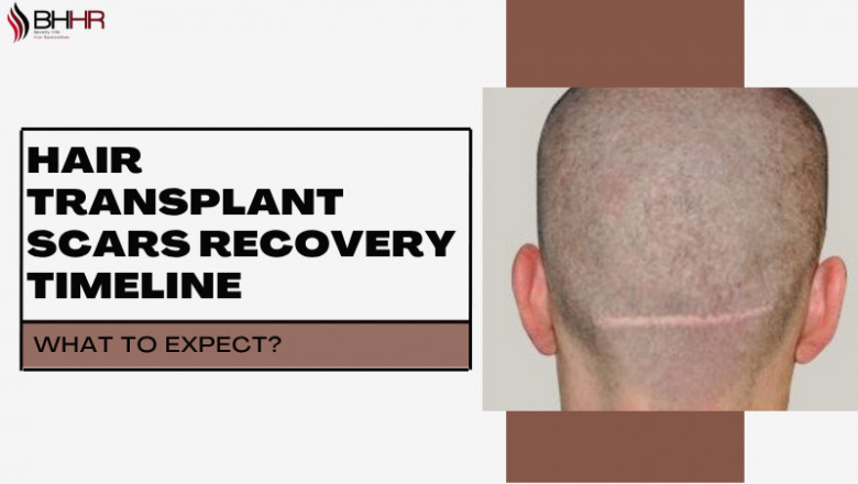 Are Hair Transplant Scars Permanent? Here's the Truth